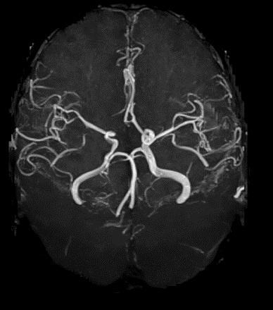 Angiografía cerebral (MRA)