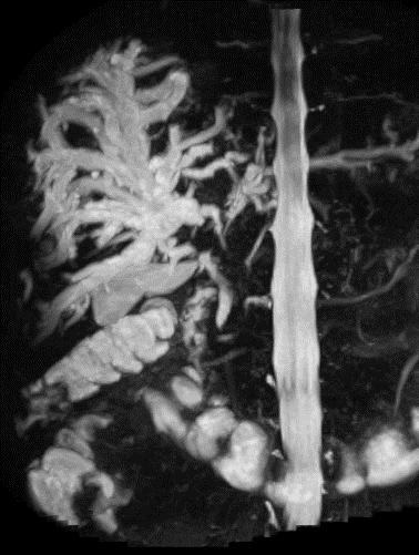 Colangiopancreatografía (MRCP)