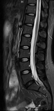 Columna lumbar, sagital