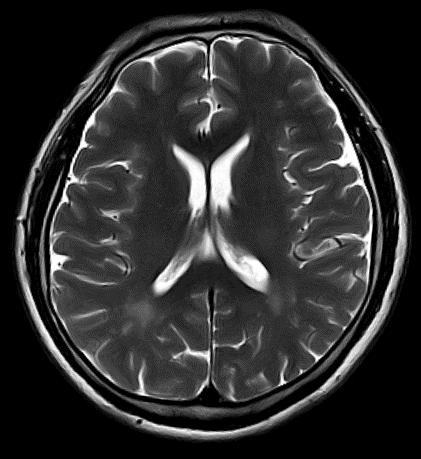 Encéfalo, T2 axial