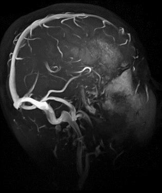 Venografía cerebral (MRV)